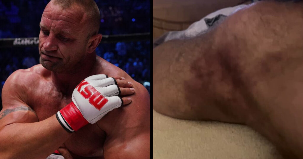 „Może nic się nie urwało?” – niepokojące zdjęcia posiniaczonej nogi „Pudziana” tydzień przed XTB KSW 77