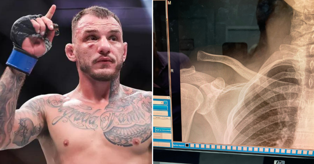 Renato Moicano z poważną kontuzją przed UFC Paris