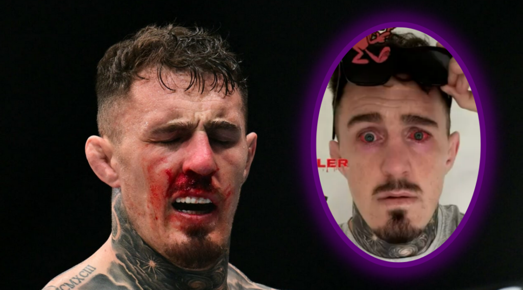 Tom Aspinall pokazał oczy po operacji. „Dzień po zabiegu” – mistrz UFC wraca do zdrowia Tom Aspinall pokazał oczy po operacji. „Dzień po zabiegu” – mistrz UFC wraca do zdrowia